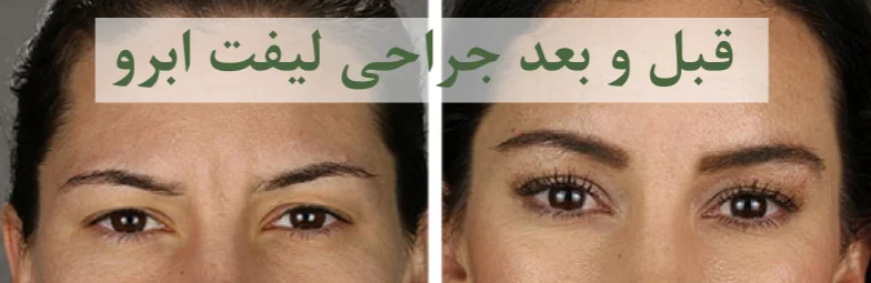 قبل و بعد عمل جراحی لیفت ابرو
