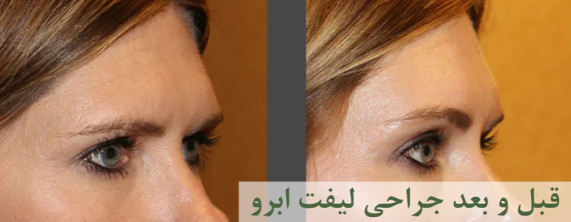 عکس قبل و بعد عمل لیفت ابرو