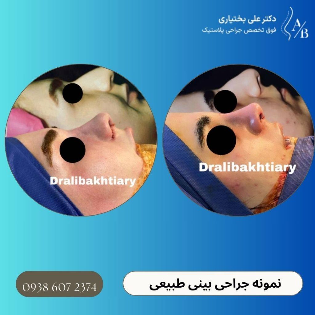نمونه جراحی بینی طبیعی