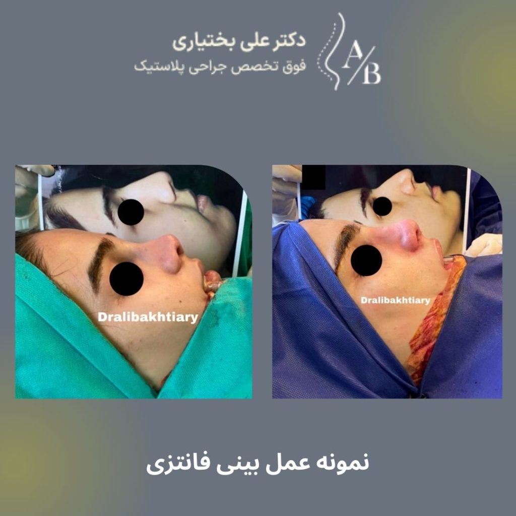 نمونه جراحی بینی فانتزی