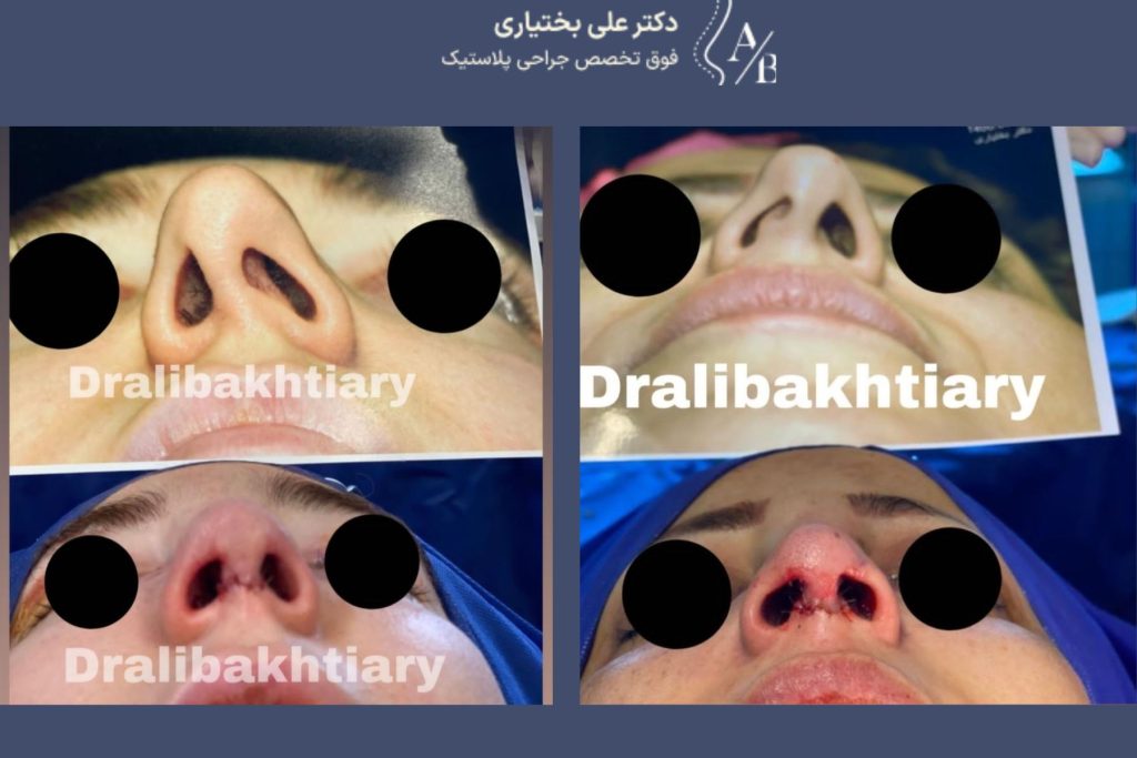 نمونه جراحی بینی
