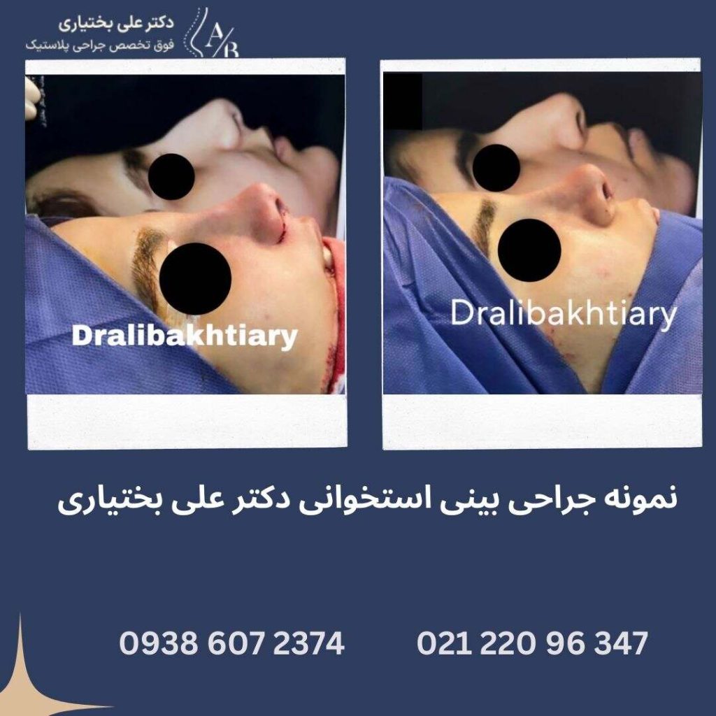 نمونه عمل بینی استخوانی