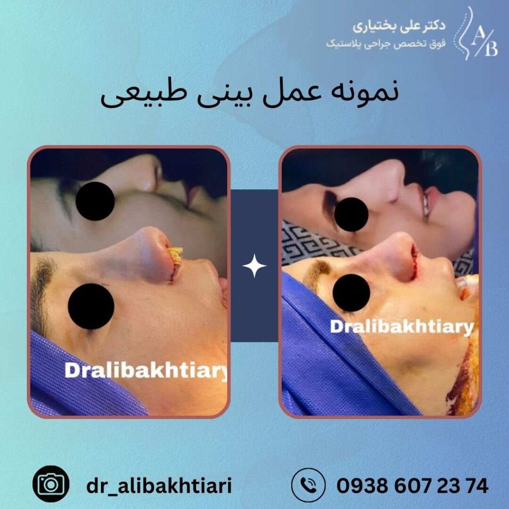 نمونه عمل بینی طبیعی
