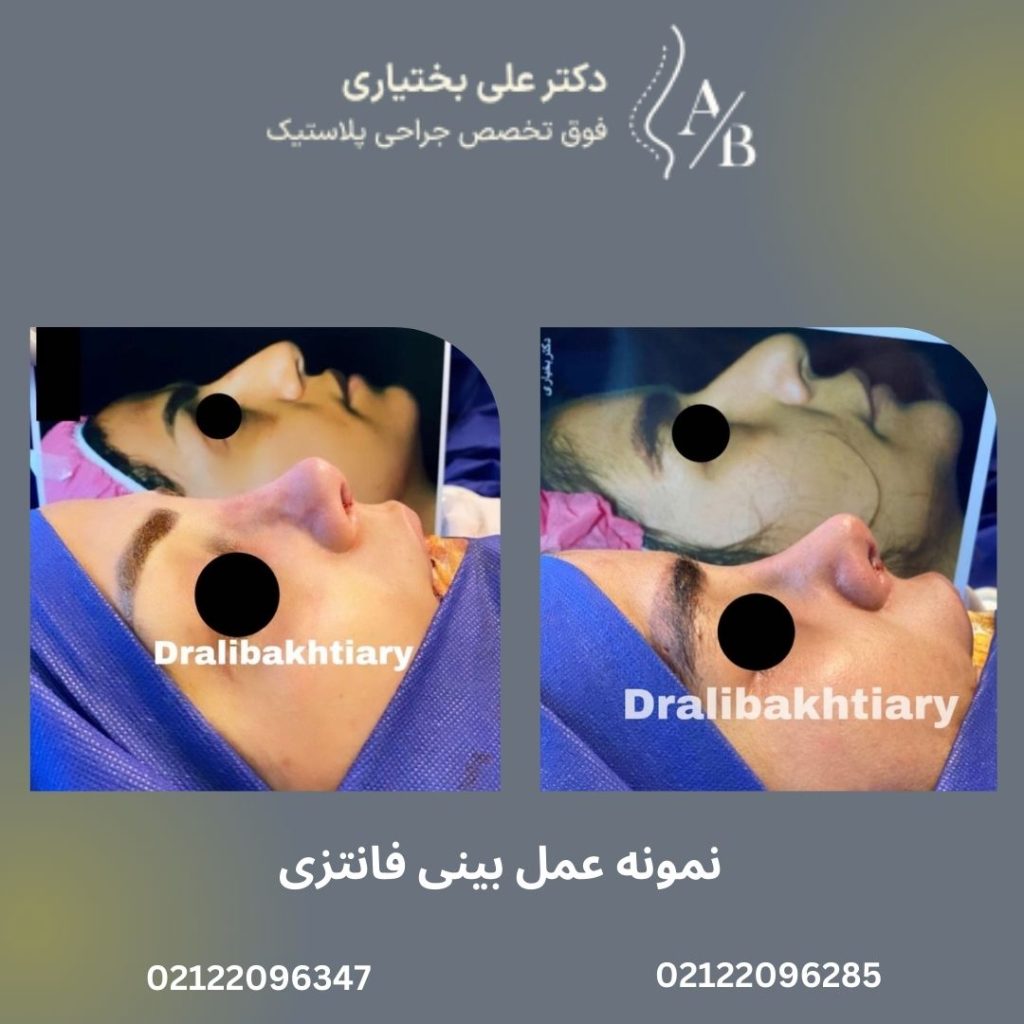 نمونه عمل بینی فانتزی