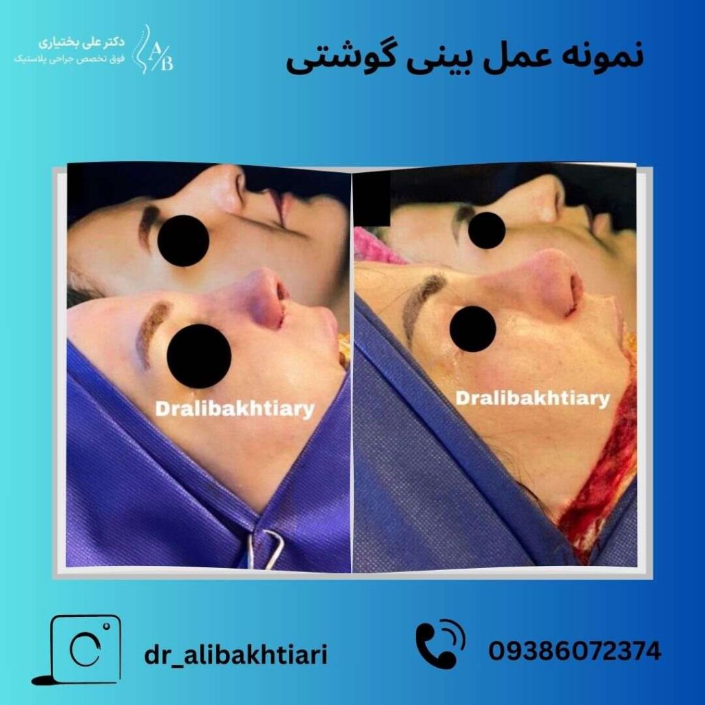 نمونه عمل بینی گوشتی