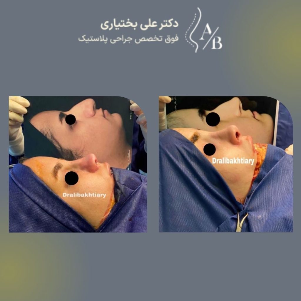 نمونه کار بهترین جراح بینی در تهران