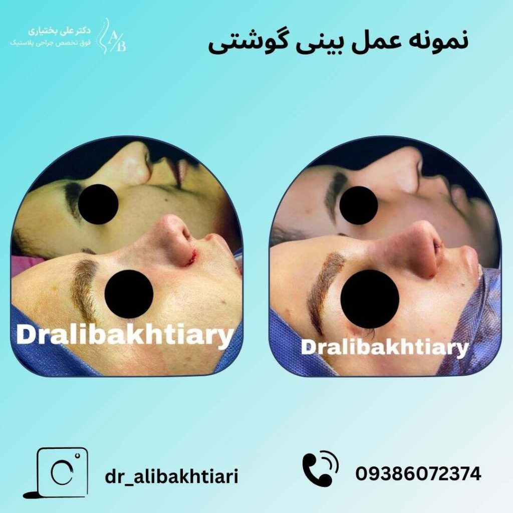 نمونه کار عمل بینی گوشتی