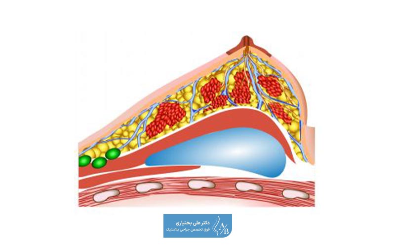 نحوه انجام جراحی پروتز سینه آناتومیک و قطره اشکی در زیر و روی عضله پستان