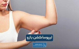 عمل جراحی لیپوساکشن بازو چیست و چه مزایایی دارد و مدت زمان بهبودی آن چقدر است؟