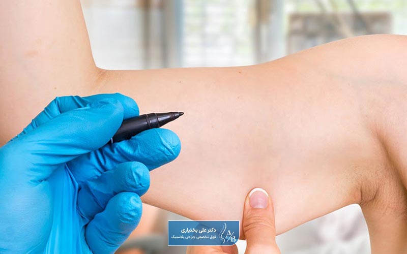 عمل لیپوساکشن بازو چیست؟ بررسی لیپو بازو