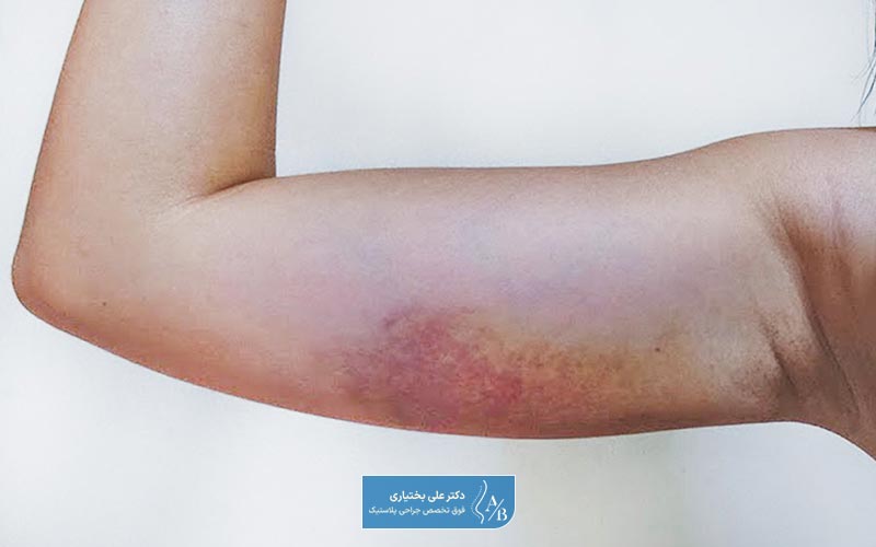 عوارض لیپوساکشن بازو به دو دسته شایع و نادر تقسیم میشود