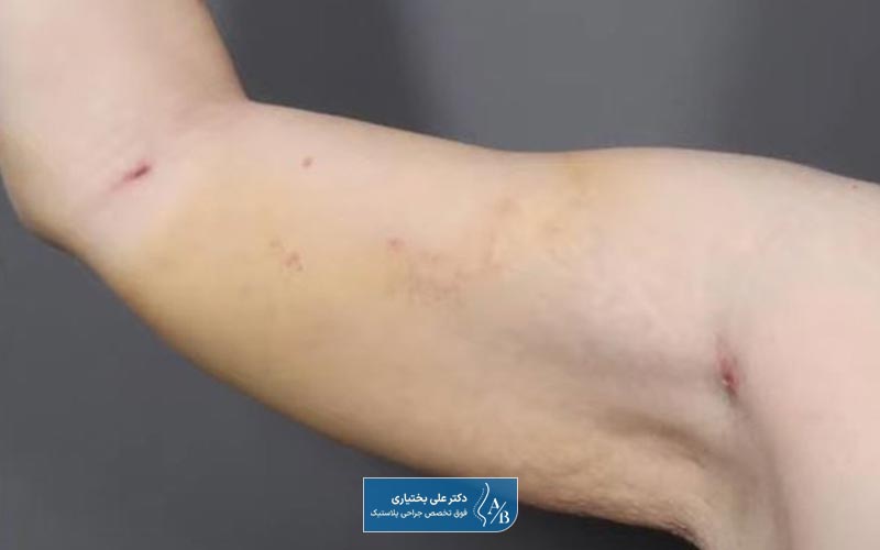 بررسی سلامت جسمی زیباجو قبل از عمل لیپوساکشن بازو