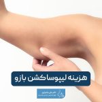 هزینه لیپوساکشن بازو در سال ۱۴۰۴ چقدر است؟ بررسی عوامل موثر بر قیمت عمل لیپو بازو در تهران