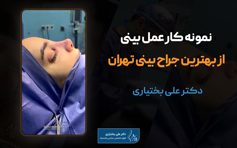 عکس نمونه کار عمل بینی توسط بهترین جراح بینی منسطقه سعادت آباد تهران