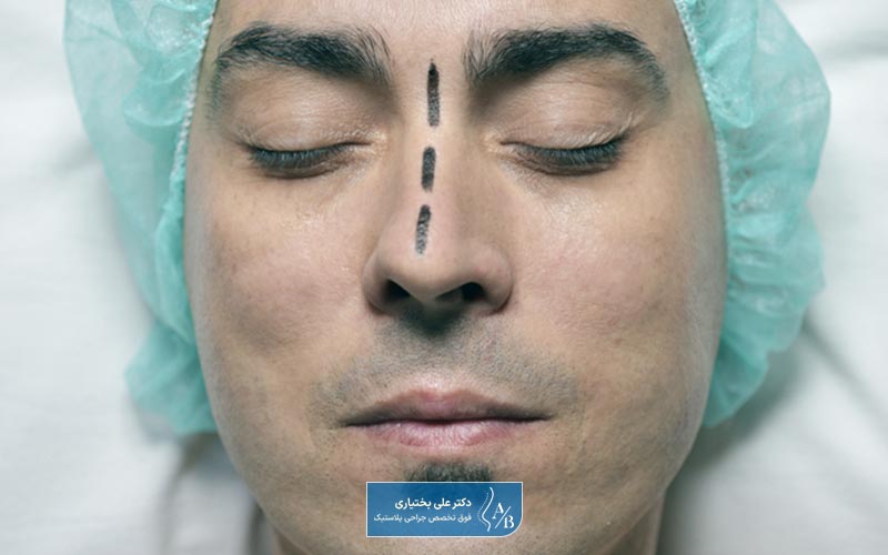 عمل بینی استخوانی طبیعی مردانه برای آقایان