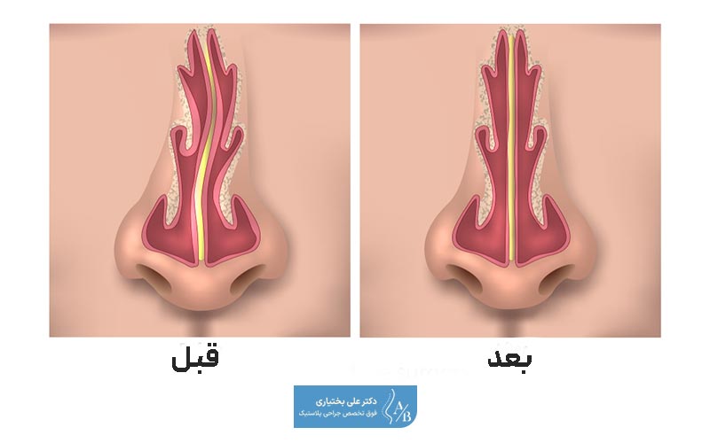 نمونه تصویر و عکس قبل و بعد از جراحی انحراف بینی استخوانی مردان و زنان