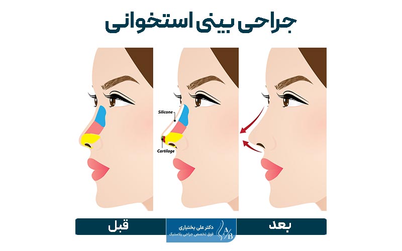 نمونه تصویر جراحی بینی استخوانی قبل و بعد