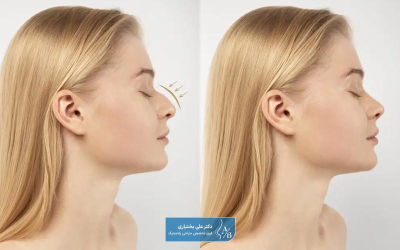 تصویر و عکس قبل و بعد از جراحی بینی استخوانی و غضروفی در سعادت آباد تهران
