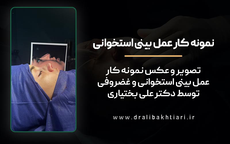 تصویر و عکس قبل و بعد نمونه کار عمل بینی استخوانی و غضروفی توسط دکتر علی بختیاری