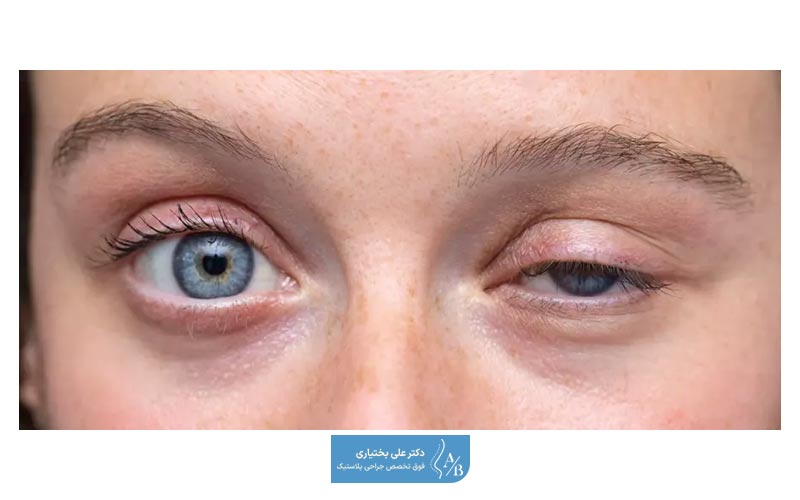 عوارض تزریق بوتاکس چیست و چه خطراتی دارد