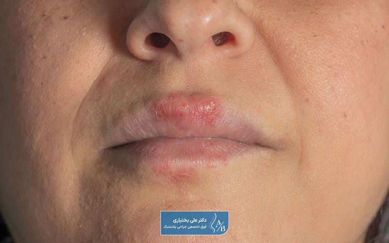 عوارض خطرناک تزریق بوتاکس کدام است؟