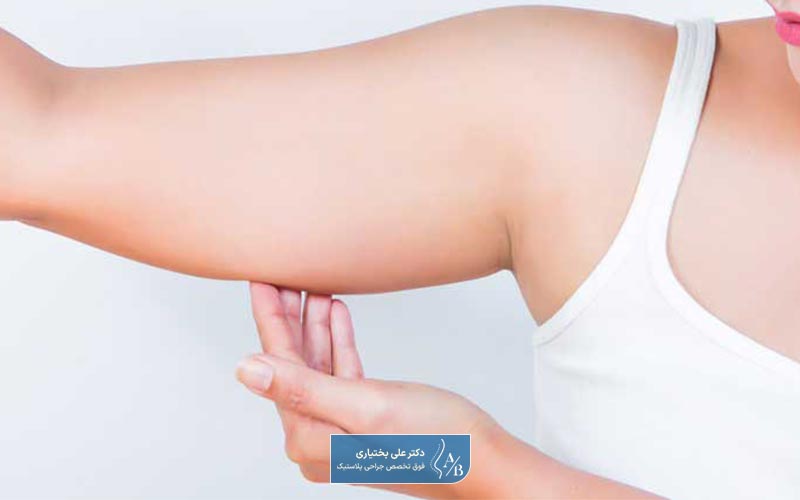 هزینه جراحی لیفت بازو در سال ۱۴۰۴ در شهر تهران چقدر است؟