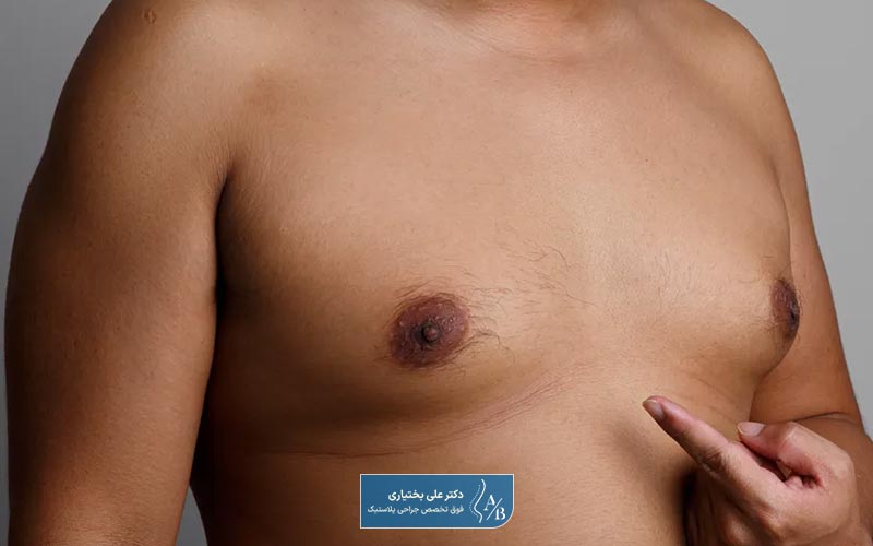 جراحی کوچک کردن سینه در آقایان و ژنیکوماستی