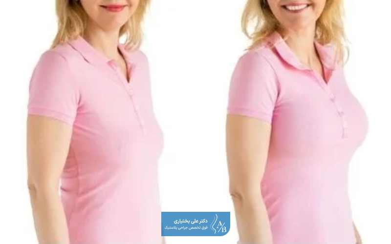 عمل لیفت سینه با ماموپلاستی رو میشه همزمان انجام داد؟