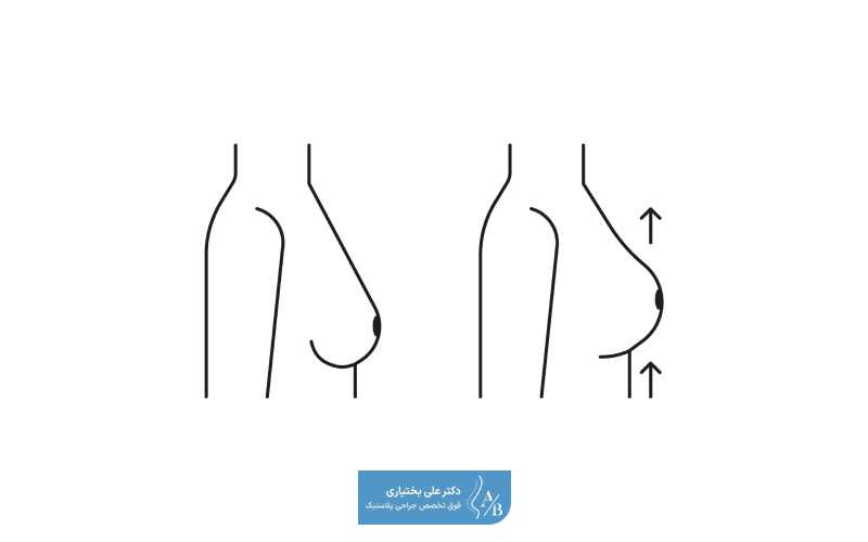 هزینه اتاق عمل یکی از عوامل موثر بر هزینه و قیمت جراحی لیفت سینه و پستان در زنان است
