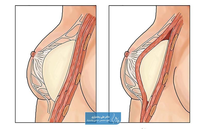 مراحل عمل پروتز سینه و تاثیر آن بر قیمت و هزینه پروتز سینه