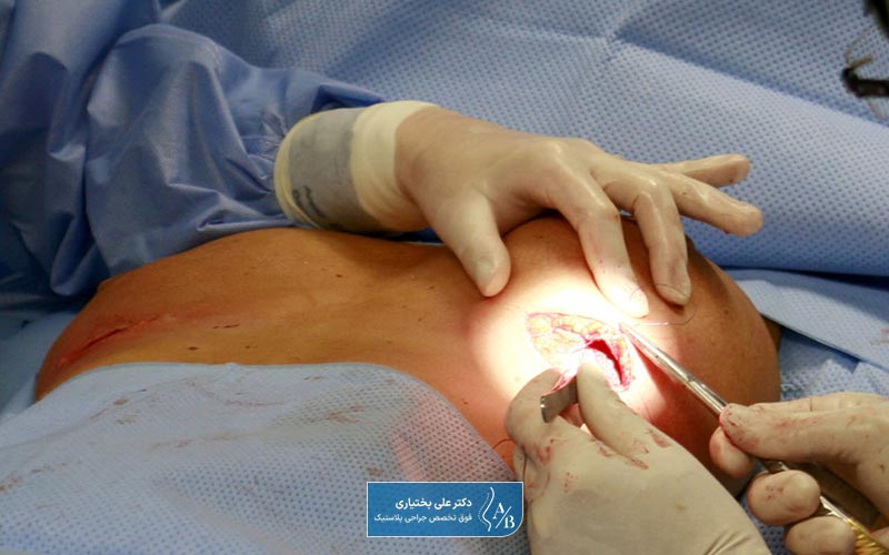 عمل ترمیمی سینه و پستان زنان چیست