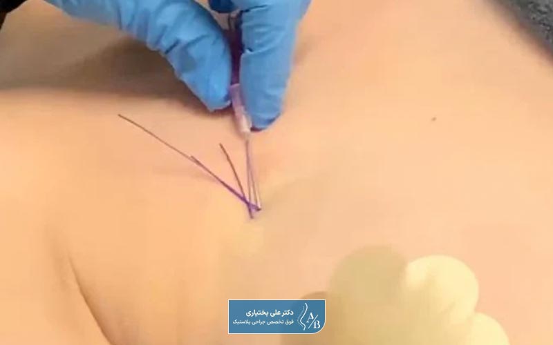 لیفت سینه با نخ و بدون جراحی چیست و چگونه انجام میشود؟