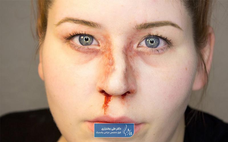 چه زمانی نیاز به عمل جراحی بینی شکسته داریم؟