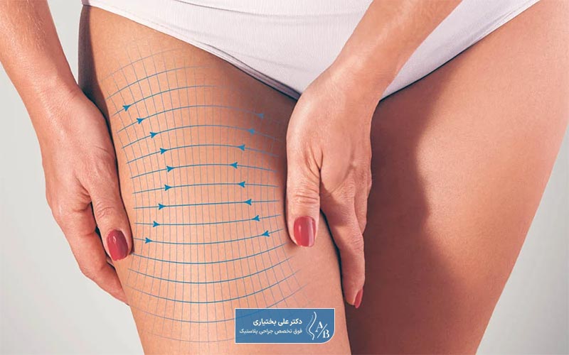 مزایای جراحی لاغری ران و باسن