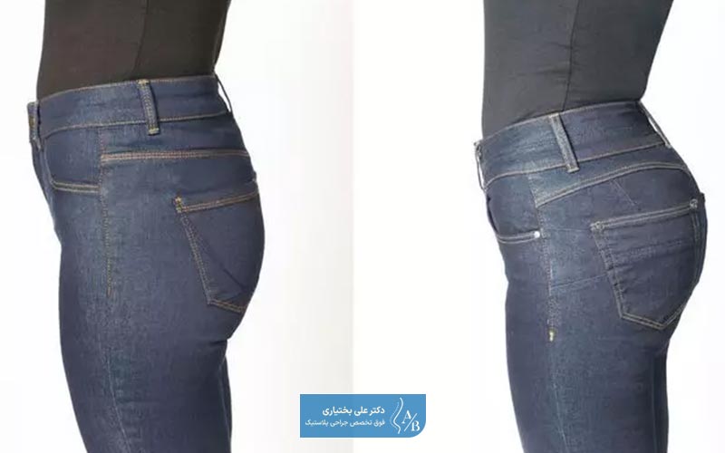 عکس قبل و بعد از تزریق چربی به باسن