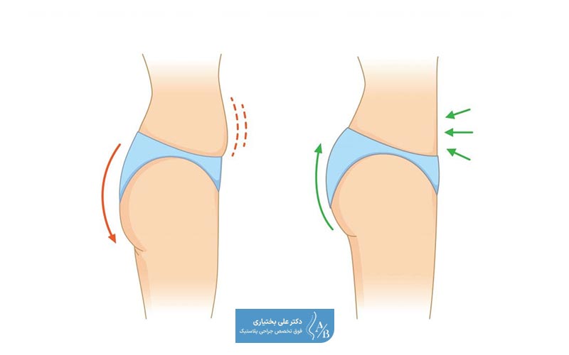تزریق چربی به باسن چیست و چه کاربردی دارد