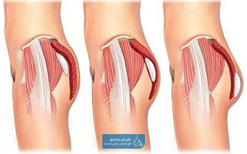 مراحل قبل و بعد از عمل جراحی پروتز باسن زنان