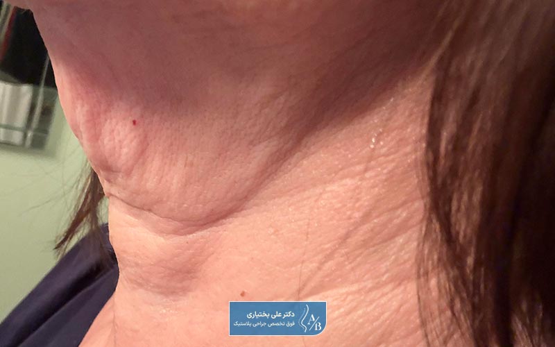 عوارض جراحی سرویکوپلاستی یا لیفت گردن