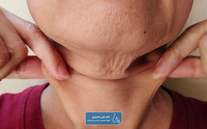 انواع روش های لیفت گردن با جراحی