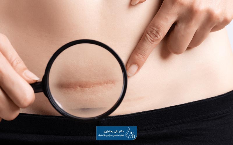 جای زخم و اسکار بعد از ابدومینوپلاستی یک از عوارض جراحی زیبایی شکم است