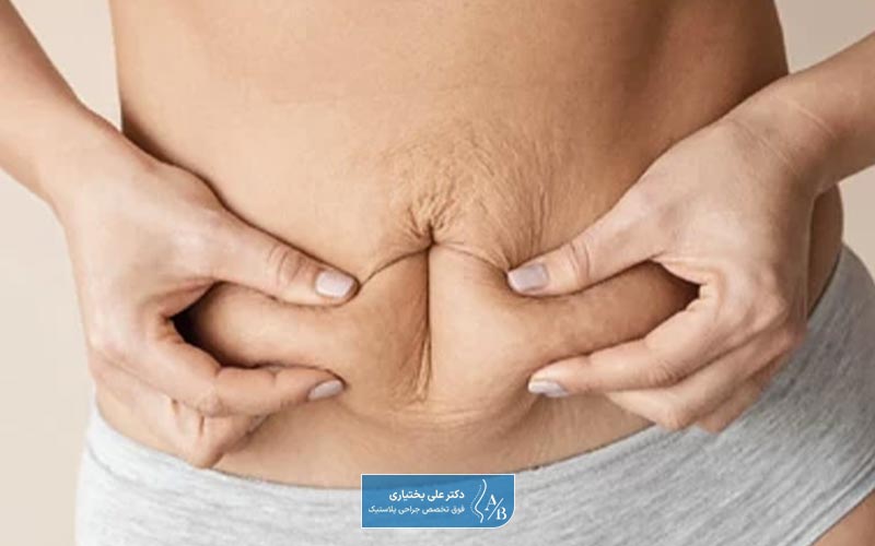 درد، تورم، خونریزی، بافت شکم و غیره همه عوارض ابدومینوپلاستی است