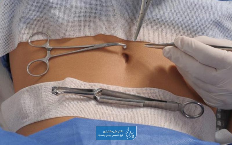 ابدومینوپلاستی چیست و هدف از انجام جراحی زیبایی شکم