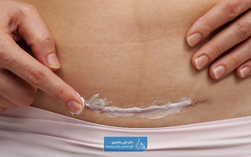 بهبود ضعیف زخم یکی دیگر از عوارض ابدومینوپلاستی است