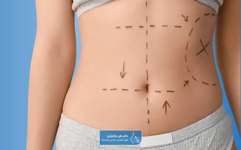 خطر آمبولی هوا و ریوی در عمل ابدومینوپلاستی و تامی تاک
