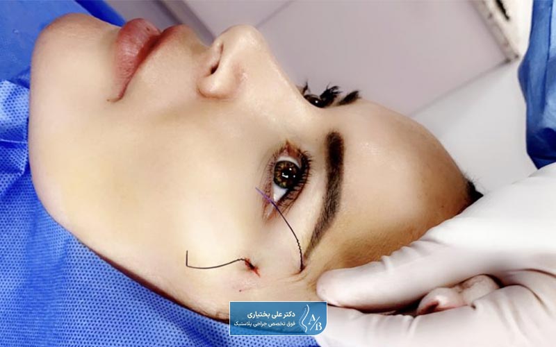بررسی مراحل لیفت ابرو با نخ توسط دکتران مجرب