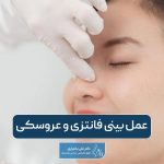 عمل بینی فانتزی و تمام مراحل جراحی بینی عروسکی در تهران