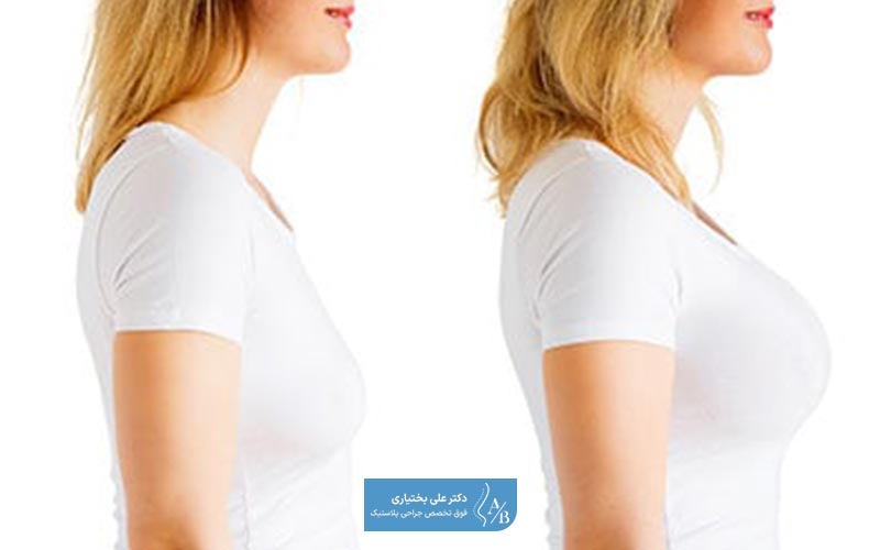 مدن زمان ماندگاری تزریق چربی به سینه چقدر است