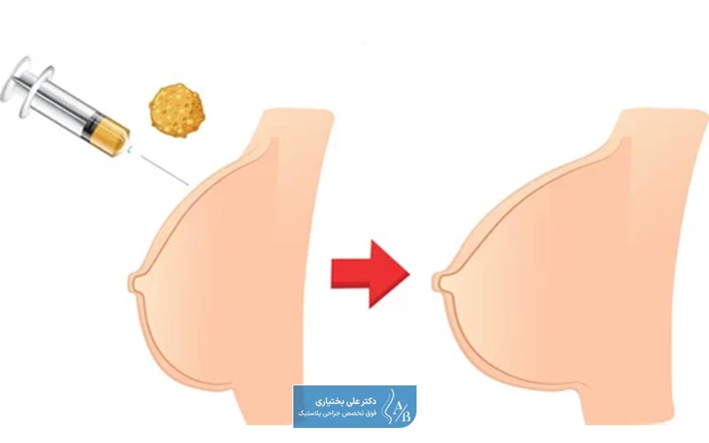 افراد مناسب و کاندید برای تزریق چربی سینه چه شرایطی دارند