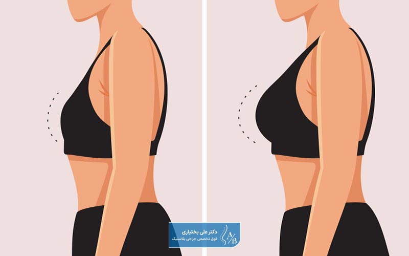 بزرگ کردن سینه با تزریق چربی به سینه چیست