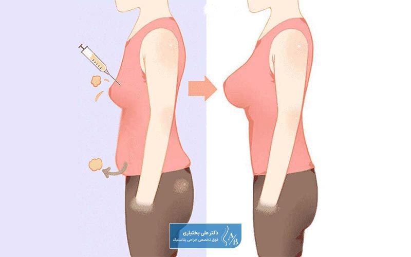 آیا تزریق چربی به پستان برای من روش مناسبی است
